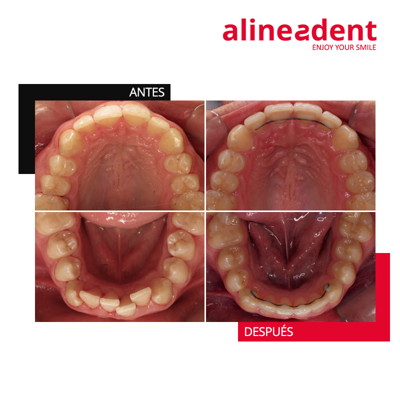 Alineadent