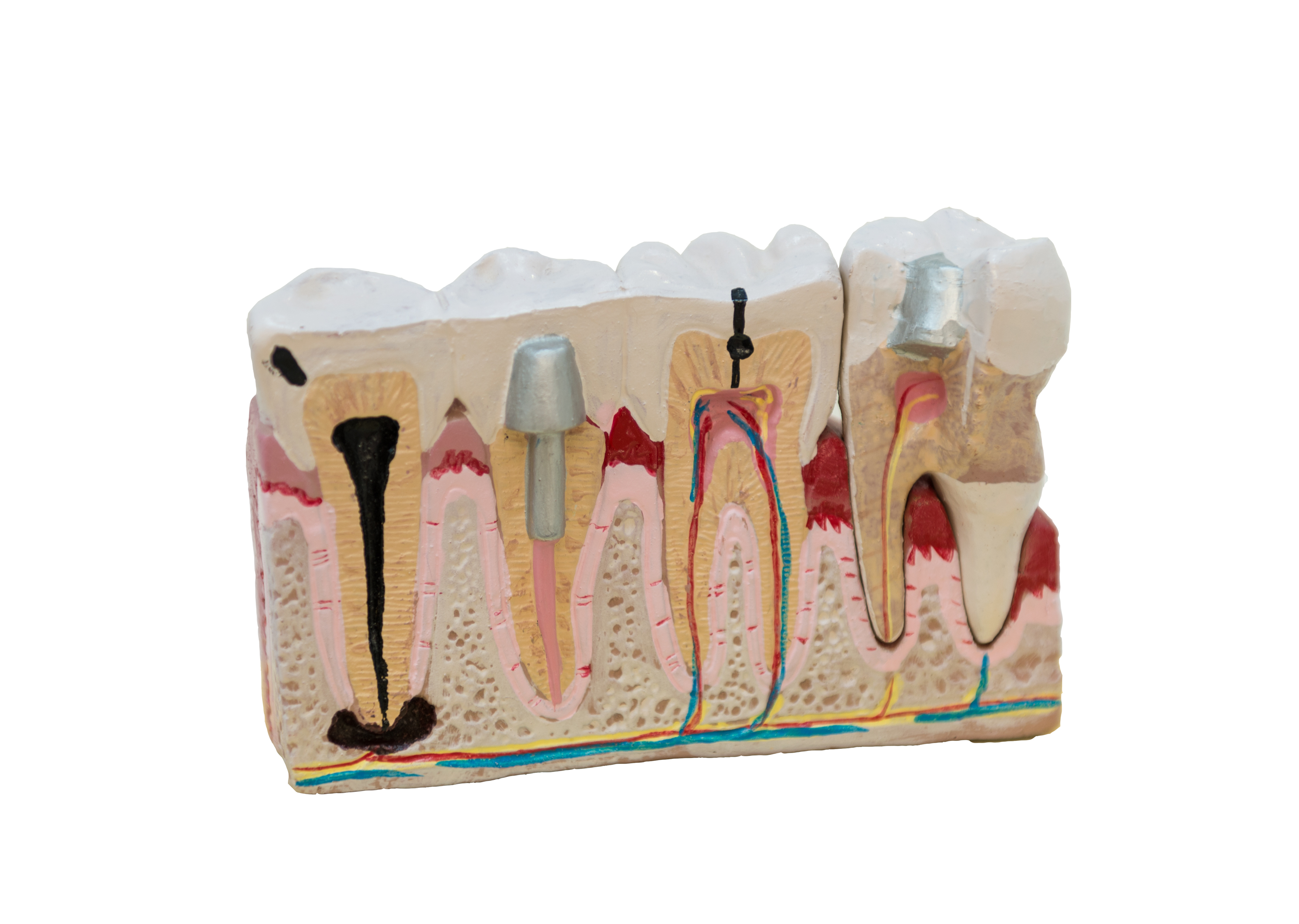 Endodoncia