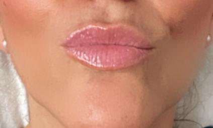 Estética Peribucal Labios